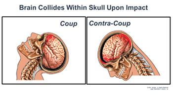 coup contrecoup brain injury